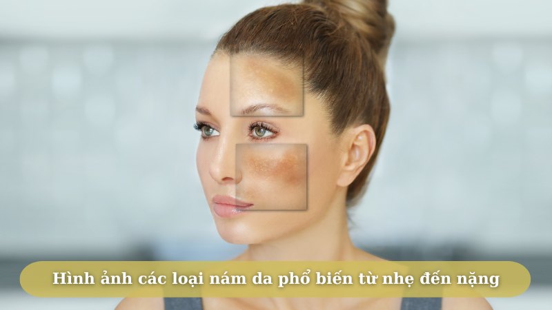 Phan biet va cach dieu tri cac loai nam da