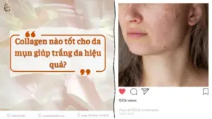 Collagen nao tot cho da mun